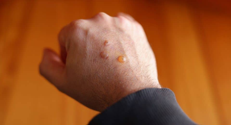 Kératose séborrhéique : traitement naturel