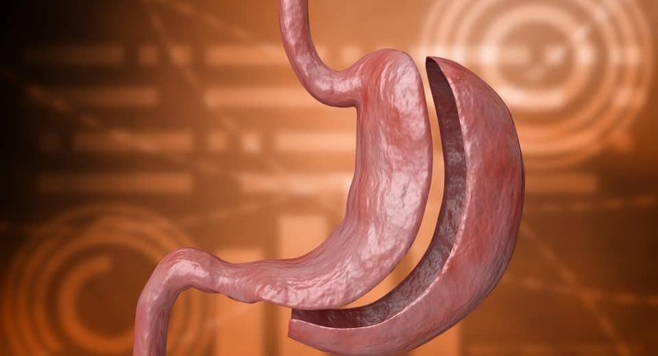 Durée de cicatrisation de l'estomac après une sleeve gastrique : infos clés