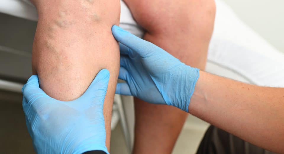 Voyager après une phlébite : attendez combien de temps avant de prendre l'avion ?