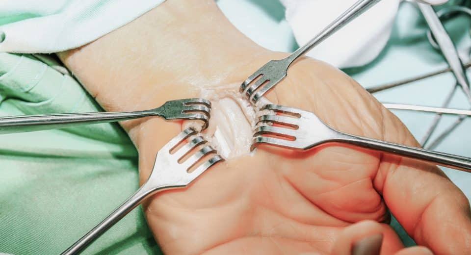 Combien de temps dure une opération du canal carpien ? durée et conseils